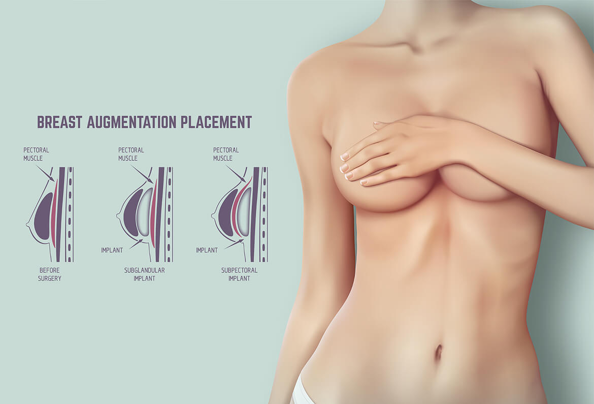 Breast augmentation surgery in Delhi